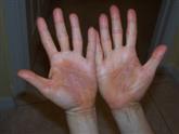 hand eczema before